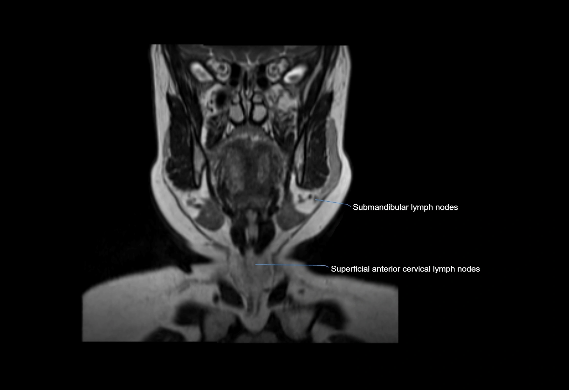 Neck coronal lymph node cross sectional MRI anatomy 3T MRI  image-img-00001-00051.webp